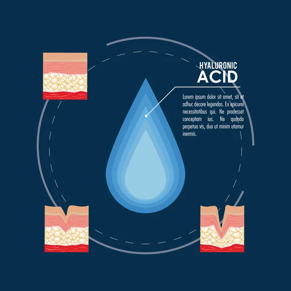 Hyaluronsyra filler injektion infographic — Stock vektor