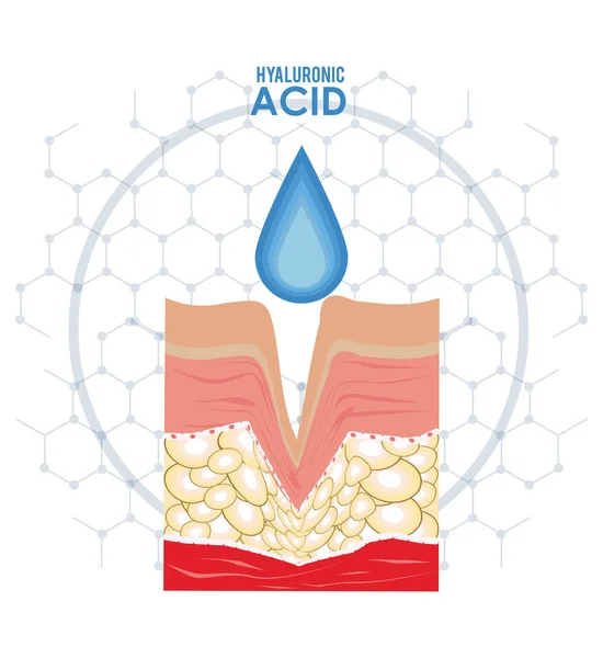 Infografica iniezione filler acido ialuronico — Vettoriale Stock