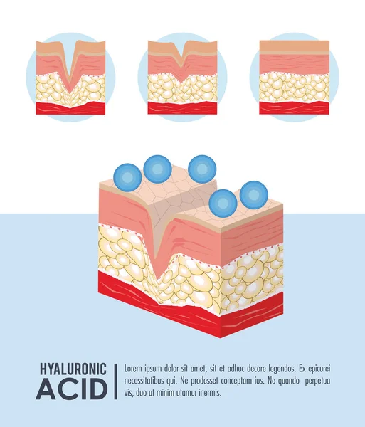 Hyaluronzuur filler injectie infographic — Stockvector