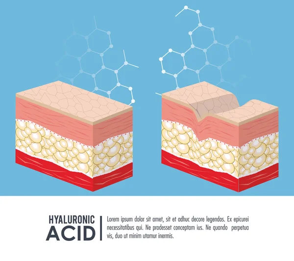 Hyaluronzuur filler injectie infographic — Stockvector