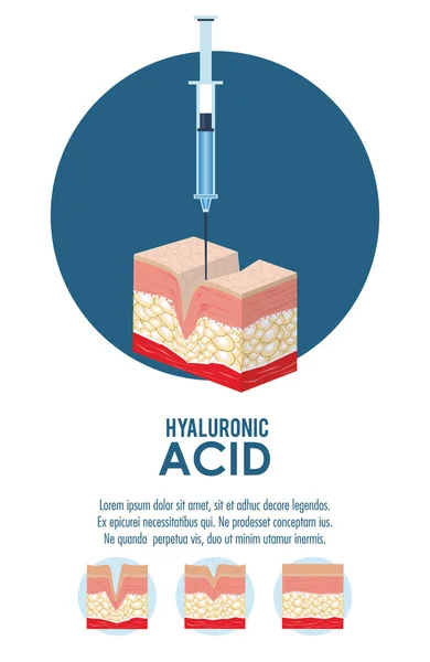 Hyaluronzuur filler injectie infographic — Stockvector