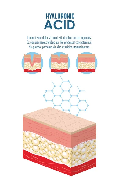 Infografica iniezione filler acido ialuronico — Vettoriale Stock