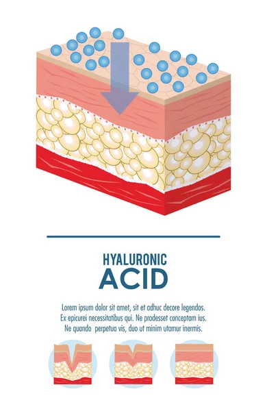 Hyaluronzuur filler injectie infographic — Stockvector