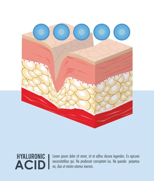Infografica iniezione filler acido ialuronico — Vettoriale Stock