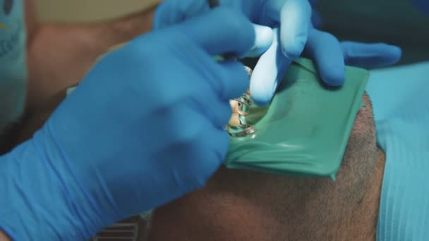 Dentista che cura un paziente usando una bara. 4K — Video Stock