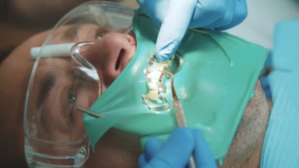 Zubař ošetřující pacienta pomocí cofferdam. 4k — Stock video