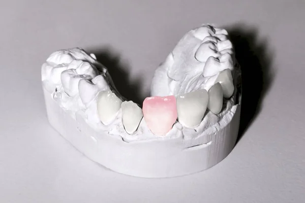 Foto Modelos Yeso Dental Mesa Concepto Diente Enfermo — Foto de Stock