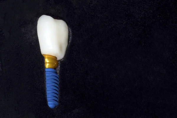 Zubní Implantát Model Černém Pozadí Prostor Pro Text Materiál Pro — Stock fotografie