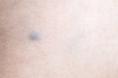 bir kadın, portre resim varis hastalığında