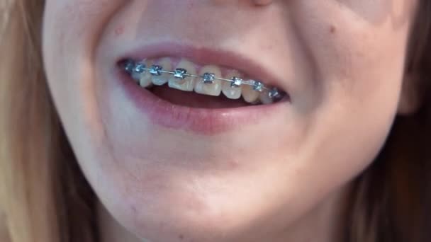 Zbliżenie młoda dziewczyna usta z szelkami na zęby. Kobieta patrząc na aparat śmiać się i uśmiechnięty. — Wideo stockowe