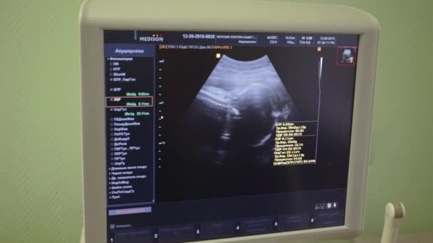 Docotr δείχνει το κεφάλι του μωρού στην οθόνη υπερήχων — Αρχείο Βίντεο