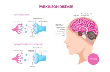 Parkinson hastalığı üzerinde kadın hasta ayrıntılı tıbbi Illustration, tıbbi Poster, bilinçlendirme kampanyası, yazı işleri, baskı ve diğer sağlık için uygun fırsat ilgili