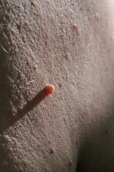 Manifestation Disease Human Papilloma Virus Neoplasm Form Papilla Close High — Stock Photo, Image