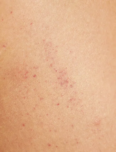 unhealthy human skin texture covered with red spots of irritation