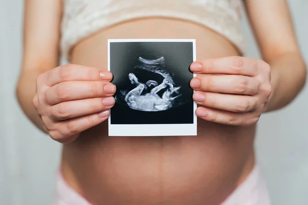 Ultraschallbild in den Händen eines schwangeren Mädchens — Stockfoto