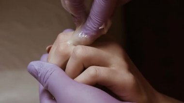 Şeker yapıştırıcısının yardımıyla parmaklarda tüy tüy dökümü prosedürü