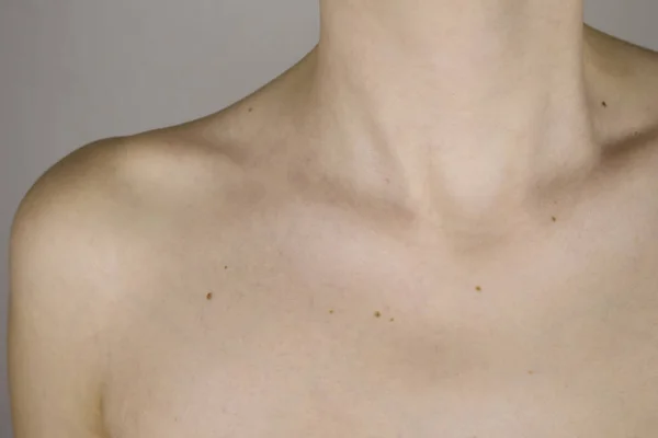 Cuello y clavícula de una niña con muchos lunares en el primer plano de la piel — Foto de Stock