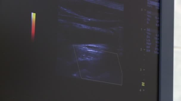Procedimiento de ultrasonido en un vídeo de pantalla — Vídeos de Stock
