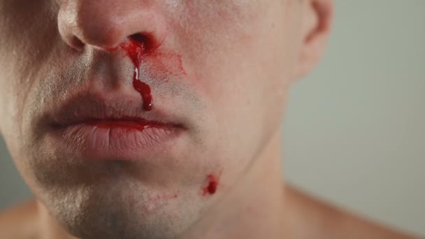 男のクローズアップ本物の鼻出血. — ストック動画