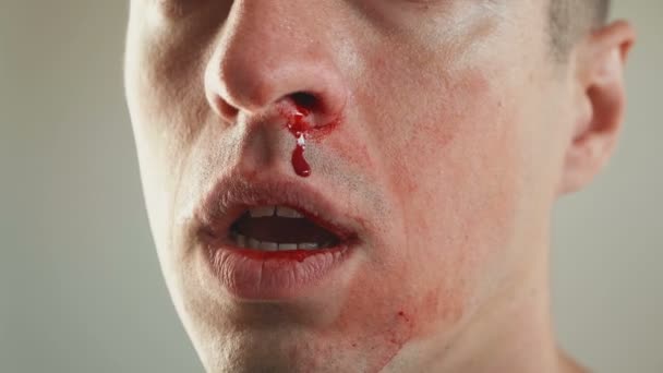 Primer plano del hombre hemorragia nasal real . — Vídeos de Stock