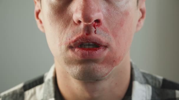 Close-Up of Man Sangramento do nariz real . — Vídeo de Stock