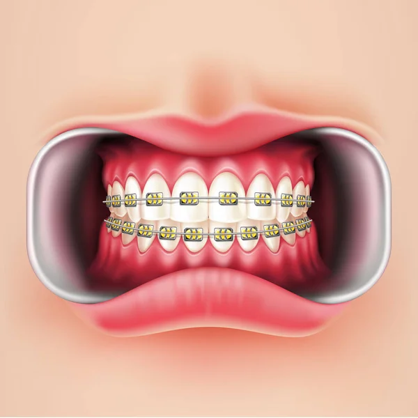 Vector dental braces, oral brakets system 3d — Stock Vector