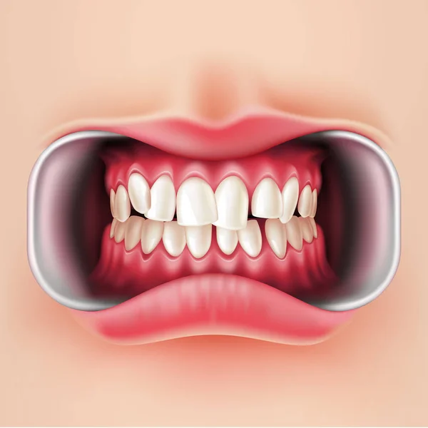 벡터 치과 중괄호, 구두 brakets 시스템 3d — 스톡 벡터