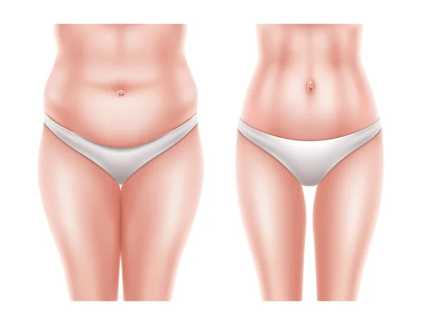 Vector liposuction surgery before after woman body — Stock Vector