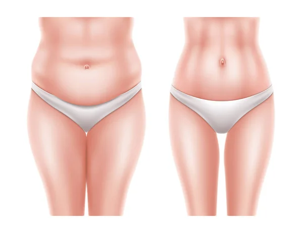 Kadın vücut sonra önce vektör liposuction cerrahi