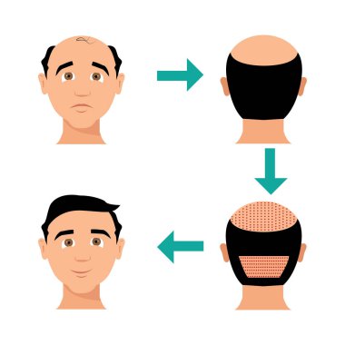 Saç dökülmesi. Dört aşamalı alopecia seti. Bölüm 8.