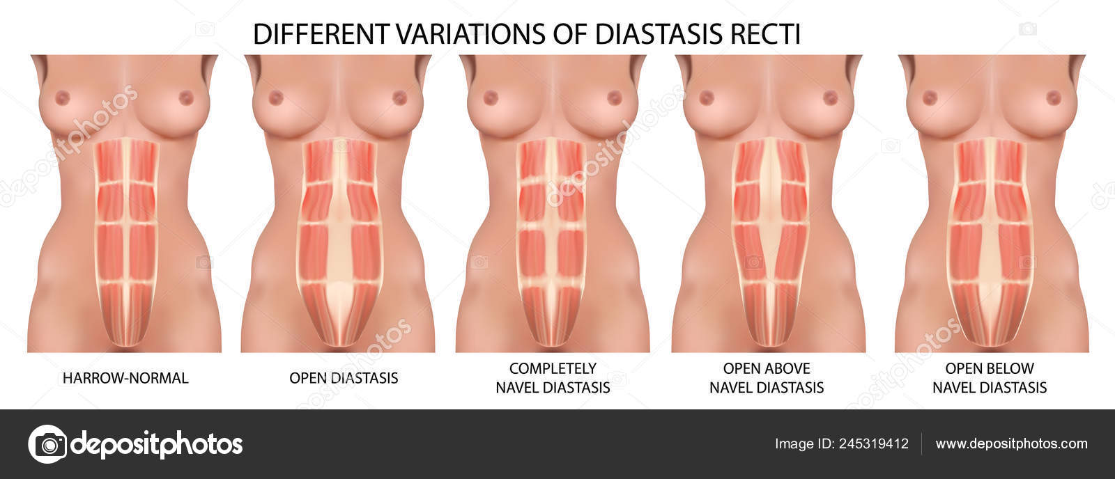 Anatomia diastática do vetor da cavidade abdominal reta, tipos e tipos de  dissecção Vetor de ©elenbushe.gmail.com 245319412, image size:1600x688