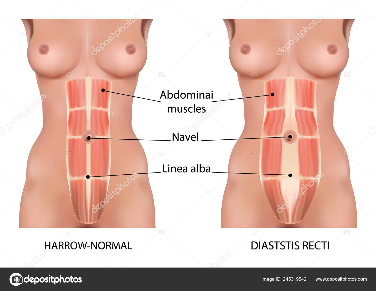 Anatomia diastática do vetor da cavidade abdominal reta, tipos e tipos de  dissecção Vetor de stock de ©elenbushe.gmail.com 245319542, image size:1600x1240