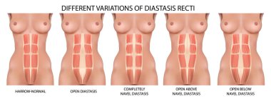 diastatic düz karın boşluğu vektör anatomi, türleri ve diseksiyon türleri