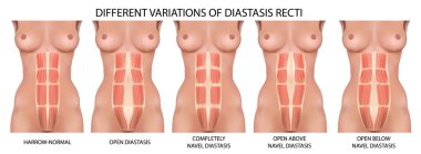 diastatic düz karın boşluğu vektör anatomi, türleri ve diseksiyon türleri