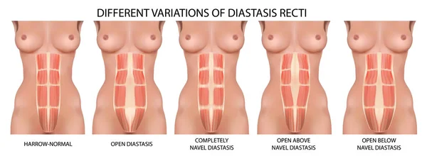 Diastatisk rakt bukhålan vektor anatomi, typer och typer av dissektion — Stock vektor