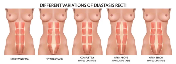 Anatomía del vector de cavidad abdominal recta diastática, tipos y tipos de disección — Archivo Imágenes Vectoriales