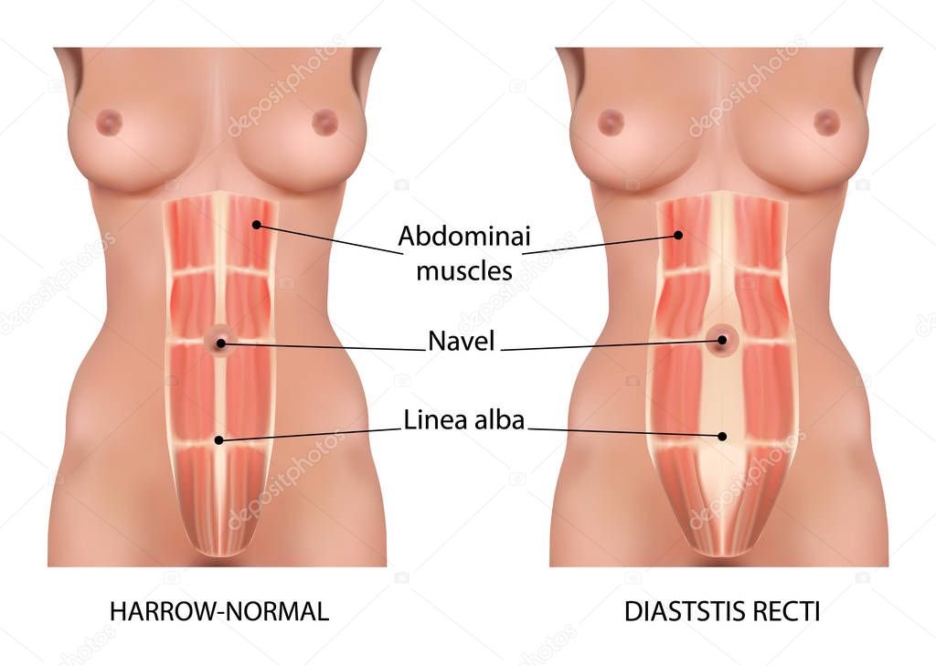 diastatic straight abdominal cavity vector anatomy, types and types of dissection