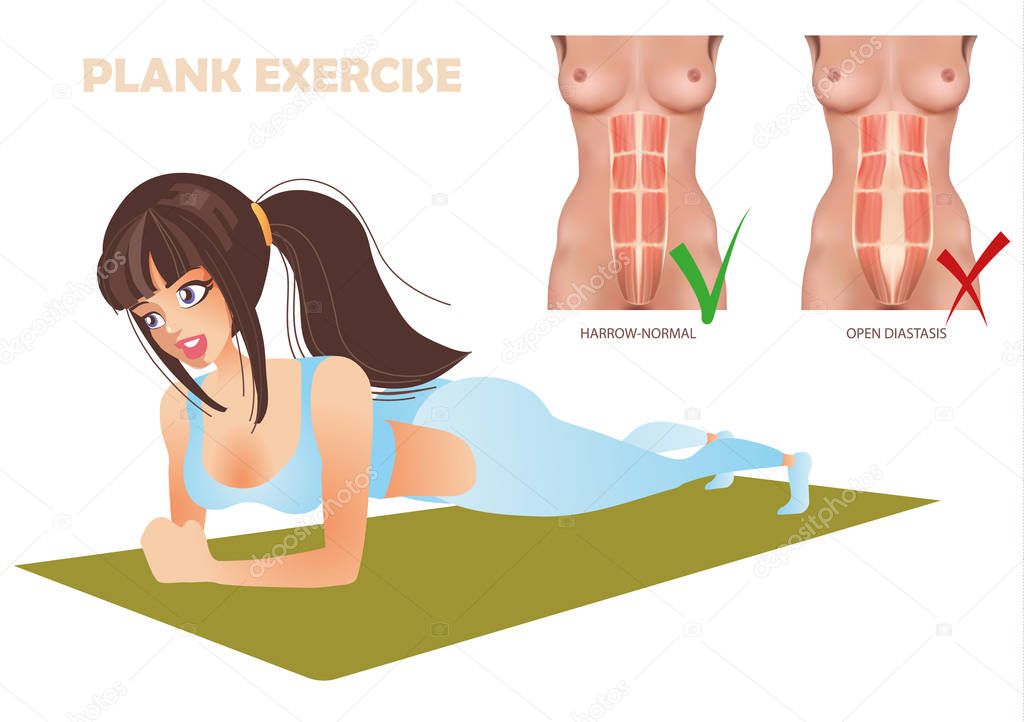 permitted and prohibited exercises for diastasis, Planck exercise
