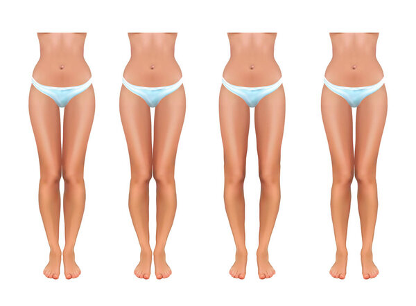 векторная иллюстрация ортопедии. valgus и varus
