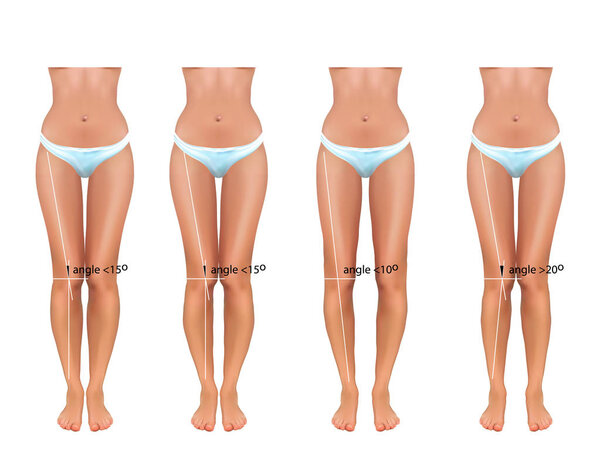 векторная иллюстрация ортопедии. valgus и varus
