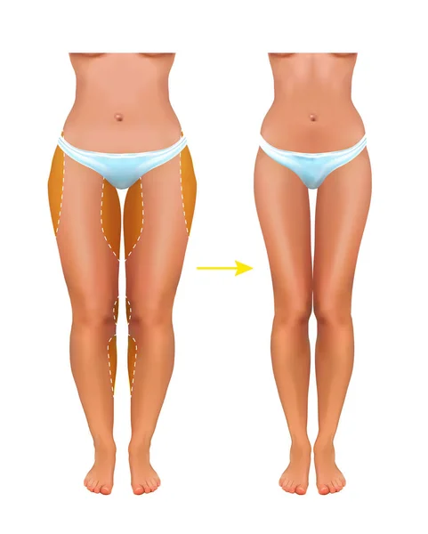 Chirurgische Linien auf schönen Frauenkörper. Vektor — Stockvektor