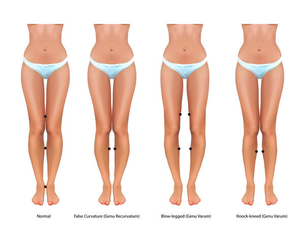 векторная иллюстрация детской ортопедии. valgus и varus
