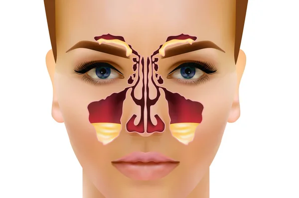 Sinusitis. Ilustración del vector sinusal nasal saludable e inflamación — Vector de stock