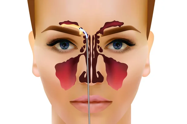 Sinusitis. Ilustración del vector sinusal nasal saludable e inflamación — Vector de stock