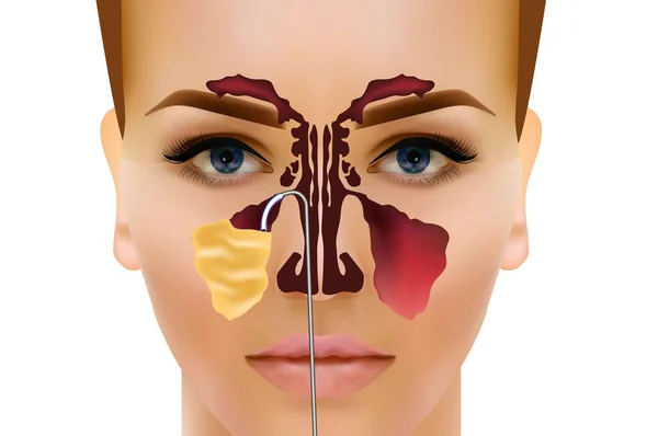 Sinusitis. Gezonde en ontsteking nasale sinus vector illustratie — Stockvector