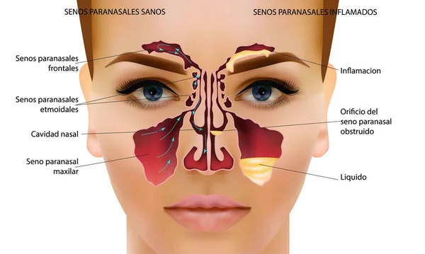 Sinusitida. Obrázek v zdravém a zánětu nosní sinusový — Stockový vektor