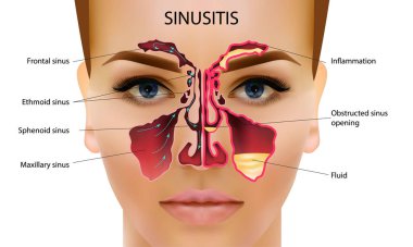 Sinüzit. Sağlıklı ve inflamasyon Burun sinüs vektör illüstrasyon