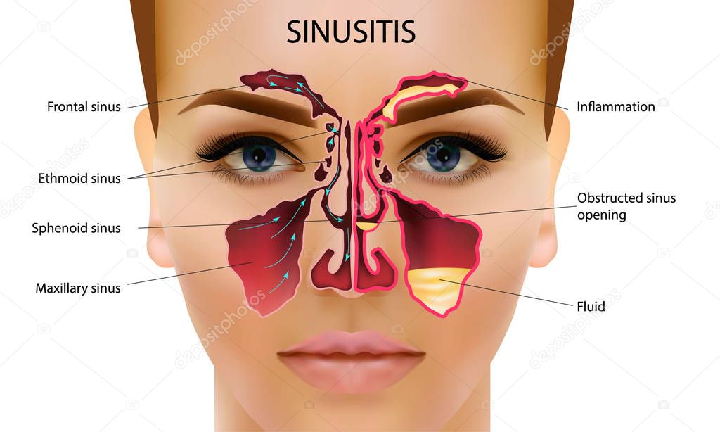 Sinusitis. Healthy and inflammation nasal sinus vector illustration