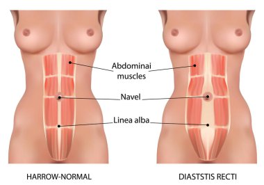 Diastasis rekti kası karın ayrımı olarak da bilinir.