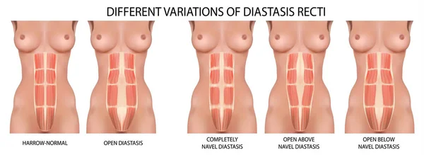 Diastase retal também conhecida como separação abdominal . — Vetor de Stock